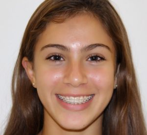 Photo of Amber and ceramic clear braces