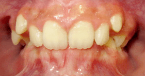 Before patient photo: Orthodontic Overbite Issue