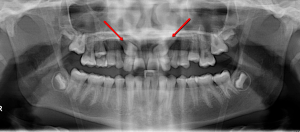 Digital patient radiograph: A before image, showing impacted upper teeth