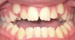 Before patient photo: Orthodontic Open Bite condition