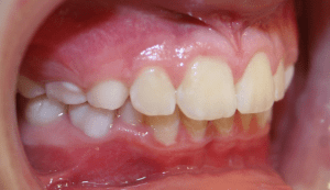 After patient photo: Orthodontic Overjet corrected with orthodontic treatments