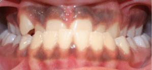 Before patient photo: Orthodontic Crossbite conditions