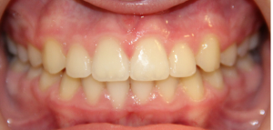 After patient photo: Properly aligned and spaced of upper and lower teeth