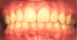 After patient photo: Orthodontic Overbite corrected