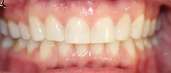 Photo: Smiling upper and lower teeth with good hygiene