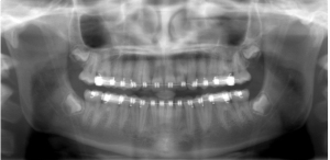 Digital patient radiograph: An after image, showing correct upper teeth in alignment
