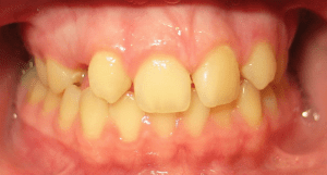 Before patient photo: Missing upper teeth and misaligned lower teeth