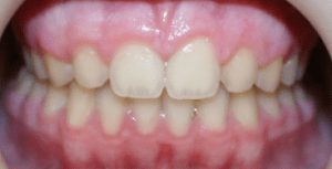 After patient photo: Upper teeth properly erupted and aligned lower teeth