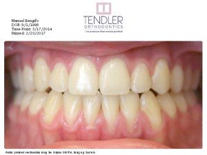 After patient photo: Orthodontic bite corrected with dental braces