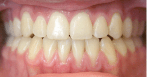 After patient photo: Orthodontic bite corrected using dental braces