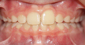 After patient photo: Properly spaced and aligned upper and lower teeth