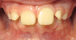 Before patient photo: Crowding and spacing of upper and lower teeth
