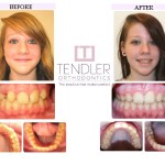 Patient Photo: Dental Braces Case 4 Before & After