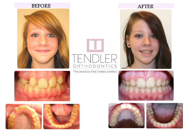 Patient Photo: Dental Braces Case 4 Before & After