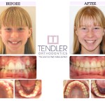Patient Photo: Dental Braces Case 3 Before & After