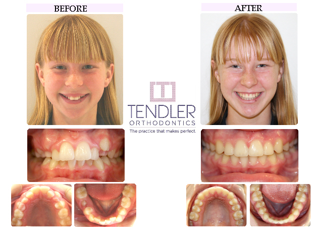 Patient Photo: Dental Braces Case 3 Before & After