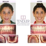Patient Photo: Dental Braces Case 2 Before & After