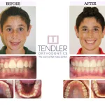Patient Photo: Dental Braces Case 2 Before & After