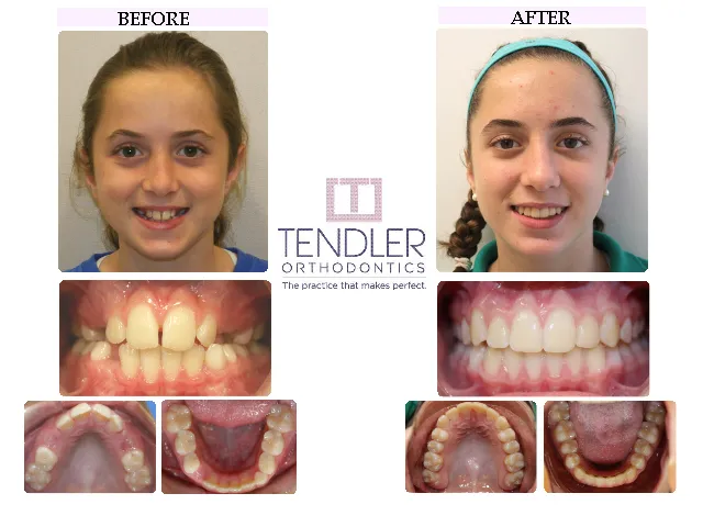 Patient Photo: Dental Braces Case 11 Before & After