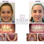 Patient Photo: Dental Braces Case 11 Before & After