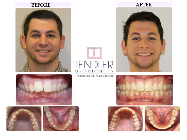 Patient Photo: Dental Braces Case 10 Before & After