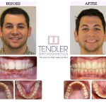 Patient Photo: Dental Braces Case 10 Before & After