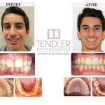 Patient Photo: Dental Braces Case 9 Before & After