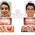 Patient Photo: Dental Braces Case 9 Before & After
