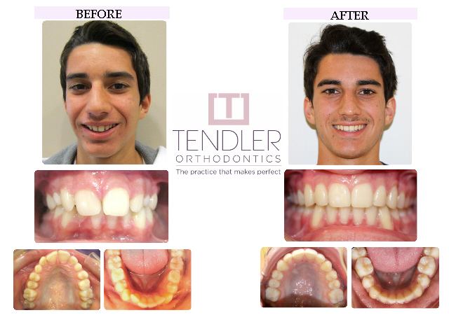 Patient Photo: Dental Braces Case 9 Before & After