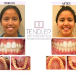 Patient Photo: Dental Braces Case 8 Before & After