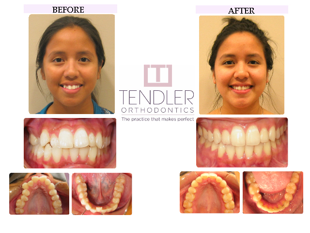 Patient Photo: Dental Braces Case 8 Before & After