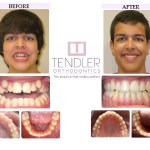 Patient Photo: Dental Braces Case 7 Before & After