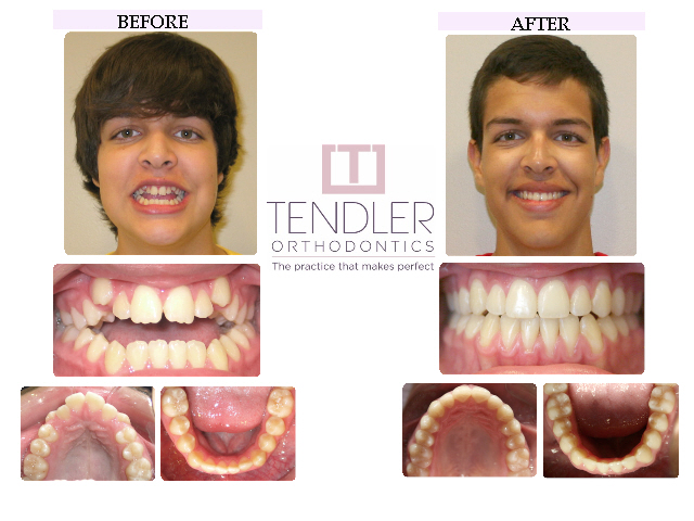 Patient Photo: Dental Braces Case 7 Before & After