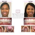 Patient Photo: Dental Braces Case 6 Before & After