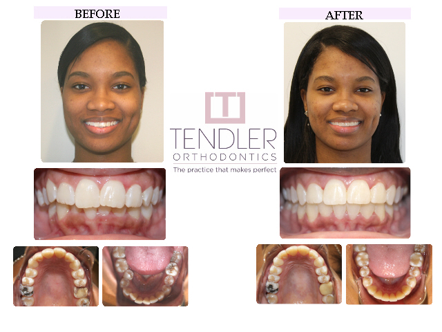 Patient Photo: Dental Braces Case 6 Before & After