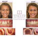 Patient Photo: Dental Braces Case 5 Before & After