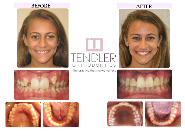 Patient Photo: Dental Braces Case 5 Before & After