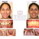 Patient Photo: Dental Braces Case 12 Before & After