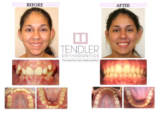 Patient Photo: Dental Braces Case 12 Before & After