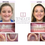 Patient Photo: Dental Braces Case 1 Before & After