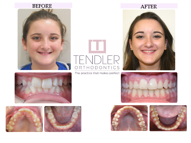 Patient Photo: Dental Braces Case 1 Before & After