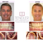 Patient Photo: Invisalign Case 3 Before & After