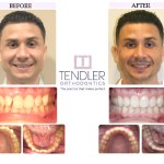 Patient Photo: Invisalign Case 4 Before & After