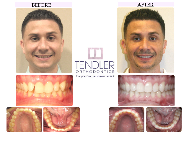 Patient Photo: Invisalign Case 4 Before & After