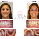 Patient Photo: Invisalign Case 5 Before & After