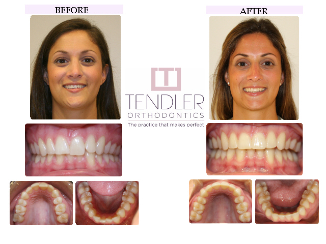 Patient Photo: Invisalign Case 5 Before & After