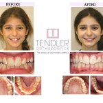 Patient Photo: Invisalign Case 6 Before & After