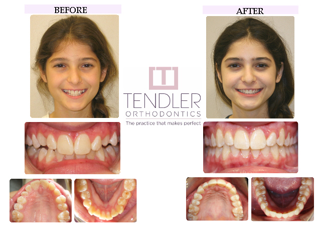 Patient Photo: Invisalign Case 6 Before & After