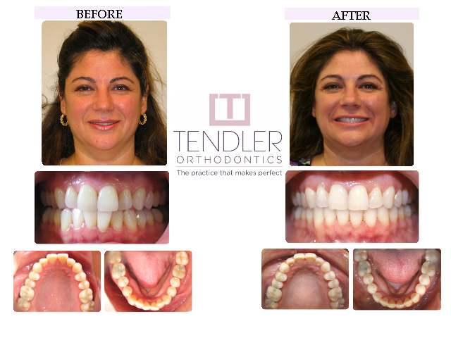 Patient Photo: Invisalign Case 7 Before & After