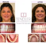 Patient Photo: Invisalign Case 7 Before & After